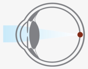 Presbyopia Is A Natural Aging Process That Usually - Circle