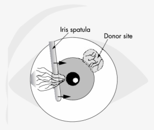 Blunt Dissection Of The Pterygium Head - Circle