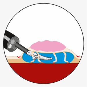 Preparation Of Submucosal Space Can Be Assisted By - Circle