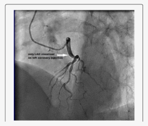 Lao Cranial View Reveals Only Lad On Left Coronary - Left Coronary Artery