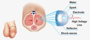Canadian Pharmacy Survey Of The Latest Viagra Alternative - Peyroni Tedavisi