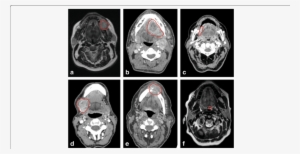 Primary Tumors Of Six Patients Encircled In Red - Neoplasm