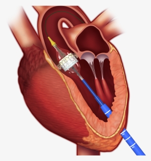 Current Team Members - Aortic Stenosis Treatment