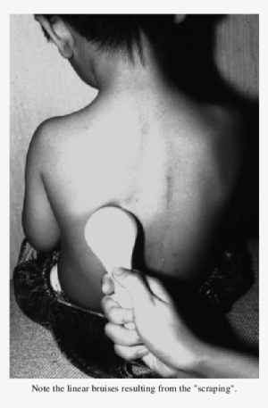 "scraping Wind" In A Child With A Porcelain Spoon - Girl