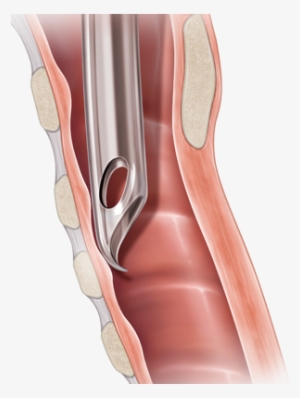 Flex-tip Endotracheal Tubes - Pediatrics