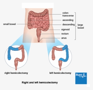 A Diagram Showing The Section Of Bowel Removed During - Right And Left Hemicolectomy