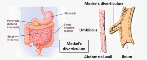 Meckel's Diverticulum - Gastroesophageal Reflux Disease