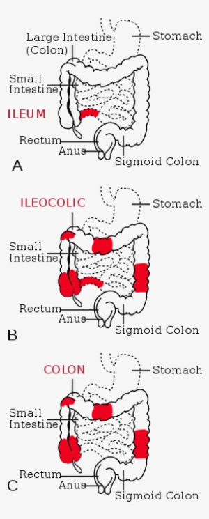 The Three Most Common Sites Of Intestinal Involvement - Chrome Disease