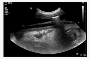 Longitudinal Image Of The Affected Small Intestine - Ultrasound