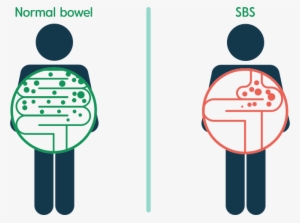 Whereas, Food And Liquid Remain In A Normal Bowel For - Short Bowel Syndrome