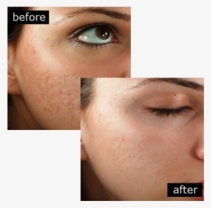 Acne Scar Removal With Outstanding Results - Philings Before And After