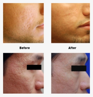 Acne Scarring Before & After Photos - Liquid Nitrogen Facial Scar