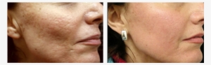 Acne Scars Treatments - Fraxel Laser Acne Scars