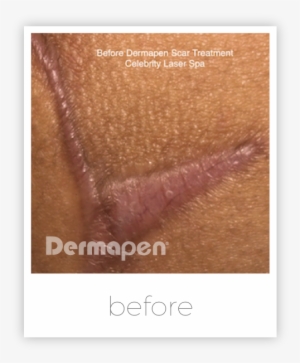 Microneedling Surgical Scars - Microneedling On Scars Before And After