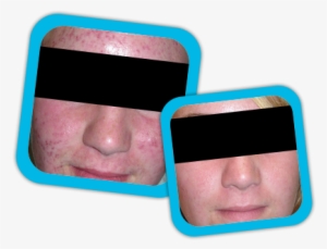 Acne Scars Result3 Acne Scars Result1 Acne Scars Result2 - Acne