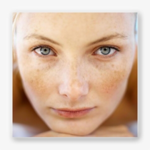 Preventing Early Acne Scars - Spots Due To Sun Exposure