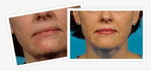 Laser Treatment Of Facial Veins In Michigan - Laser Surgery
