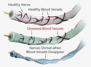 Neuropathy - Peripheral Neuropathy Nerve Damage