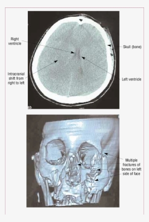 Unenhanced Ct Scans Of A - Computed Tomography