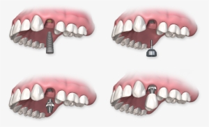 Dental Implants - Implant Healing Cap Abutment