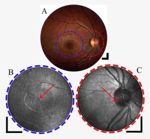 Fundus Photograph Of Subject 2 Showing The Macular - Kurbside Kitchen