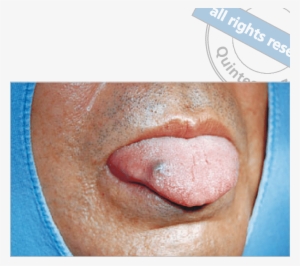 Purple Nodule Located On The Right Dorsum Of The Tongue - Purple Lump On Tongue