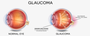Image Result For Glaucoma - Glaucoma Eye
