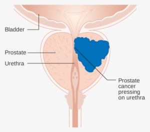 Prostate Cancer Exhibits Few Signs Or Symptoms - Prostate Cancer Androgen Receptor