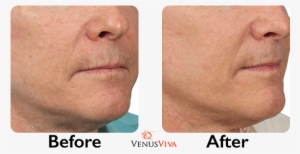 Learn More About Venus Viva™ - Venus Viva Before And After