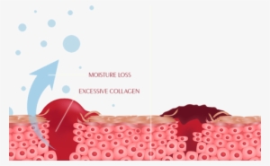 Scar Tissue Exhibits Excessive Trans Epidermal Water - Scab Formation