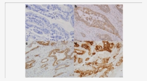 Immunostain Score Of Claudin-2 Expression In Esophageal - Esophageal Cancer