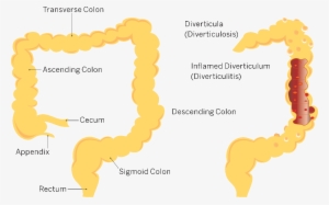 Colon-2 - Diverticulitis Transparent