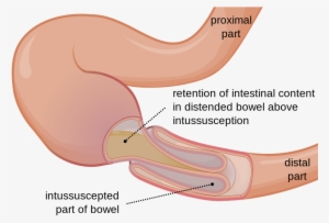 Http - Bowel Intussusception