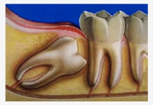 Wisdom Teeth - Wisdom Tooth
