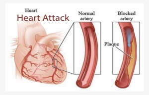 Coronary Artery Disease คือ