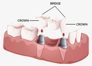 Crowns & Bridges - Dental Crowns And Bridges