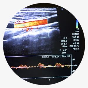 Arm Blood Clot Ultrasound