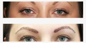 Trasplante De Cejas Antes Y Después - Eyebrow