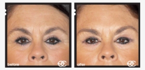 Before And After Botox - Does Botox Work