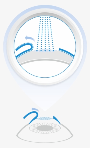 Lasik - Photorefractive Keratectomy