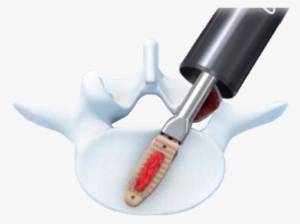 Opal Spacer System - Opal Synthes