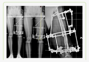Photo And X-ray Pictures During Ilizarov Frame Treatment - Ilizarov Apparatus