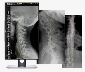 Opal-chiro Software - Digital Radiography