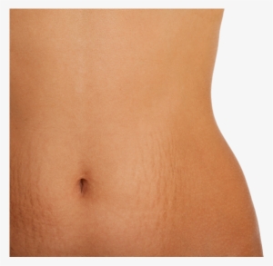 Stretch Marks Are Often The Result Of The Rapid Stretching - Mild Stomach Stretch Marks
