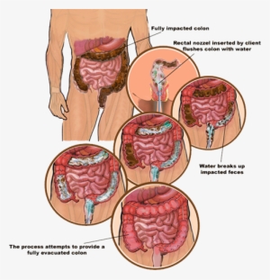 How Many Sessions Are Recommended Many Journals Written - Colonic Benefits