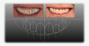 Silvestre Ripoll Clínica Dental - Diseño De La Sonrisa