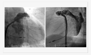 Magens Angiográficas Do Apêndice Atrial Esquerdo, Em - Left Atrial Appendage