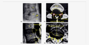 Standard Profile Of The Lumbar Sacral Spine Radiograph - Vertebral Column