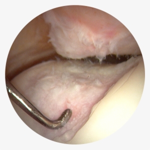 Knee Injuryand Osteoarthritis Outcome Survey Results - Arthroscopic View Of Knee Osteoarthritis