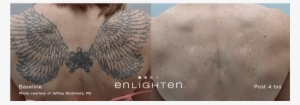 Tattoo Removal* - Tattoo Removal